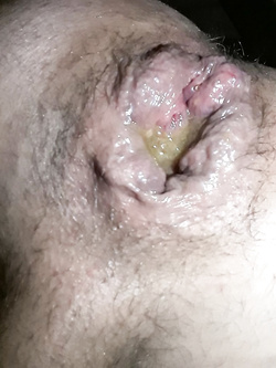 clito anal