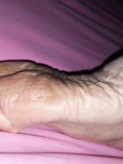 Piedi con piante callose e sporche