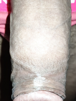 Caldo e voglie