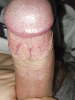 Stretching foreskin to the limit