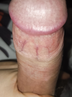 Stretching foreskin to the limit